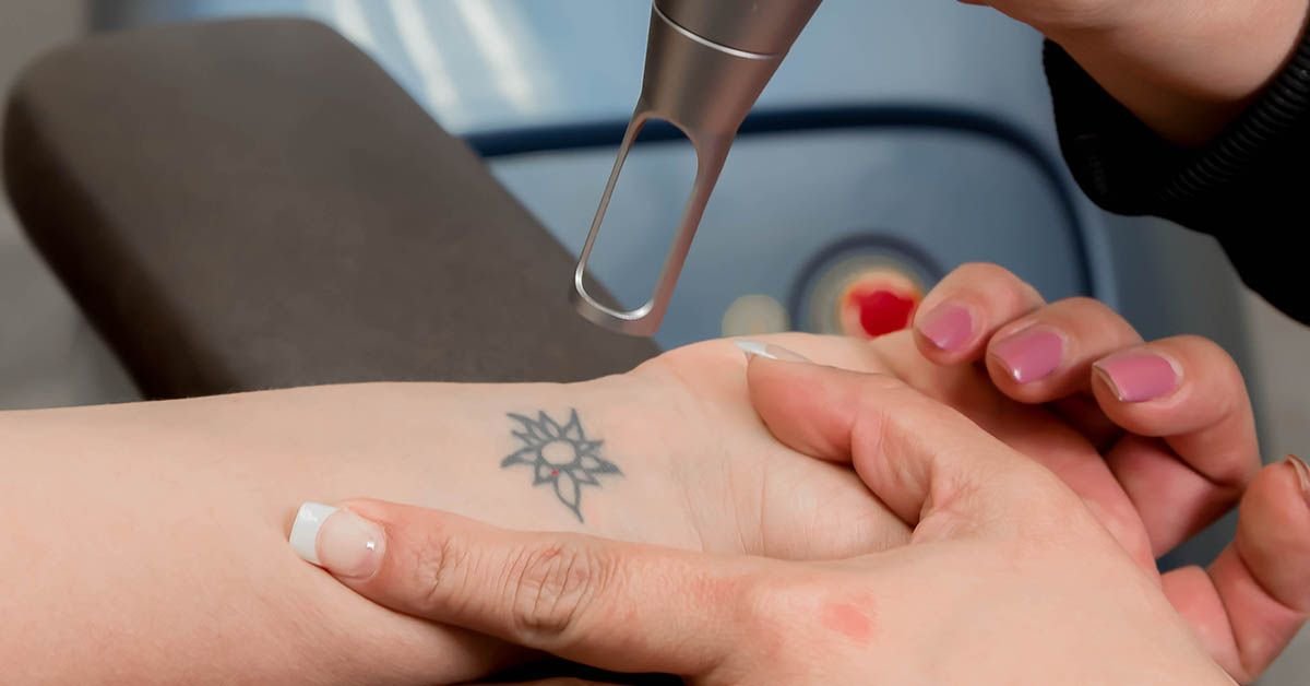 Eliminación de tatuajes con láser